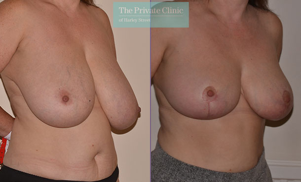 breast asymmetry correction before after results angle Adrian Richards 052AR