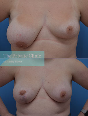 Breast Asymmetry - 007AF-Front