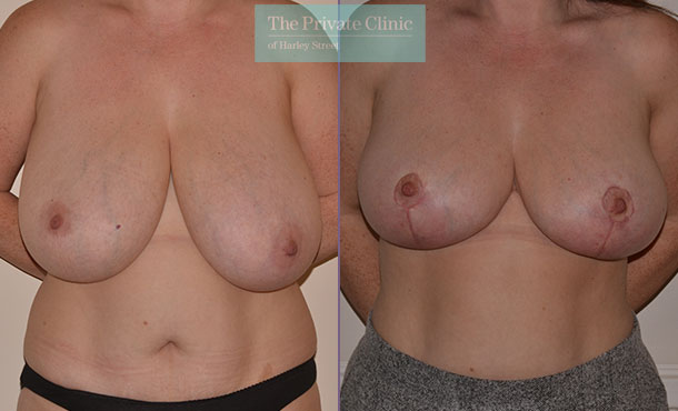 breast asymmetry surgery before after photo front Adrian Richards 052AR