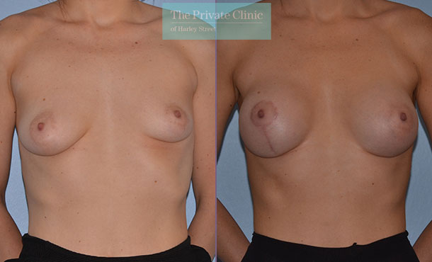 breast asymmetry surgery before after results front Adrian Richards 051AR