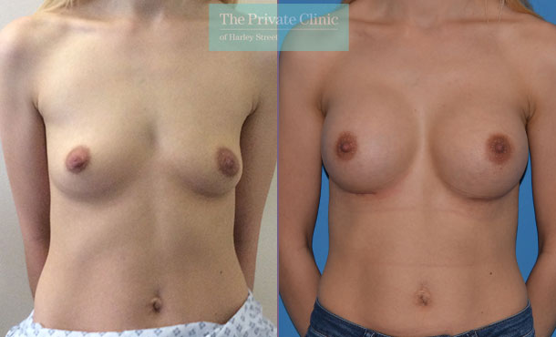 Breast Augmentation - 001AR-Front