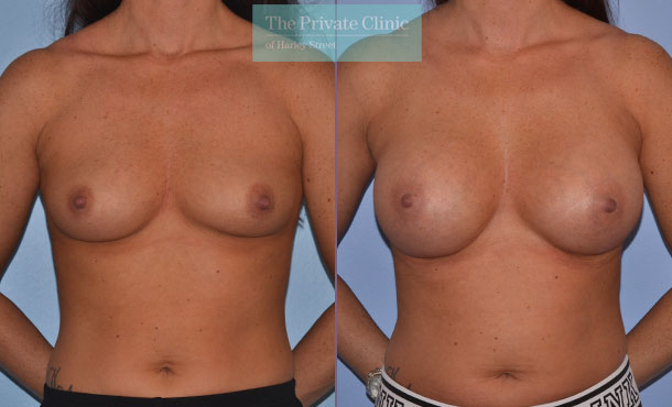 breast augmentation enlargement boob job surgery before after results mr adrian richards front 006AR