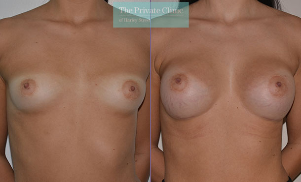 breast augmentation enlargement clinic london before after results mr adrian richards front 011AR