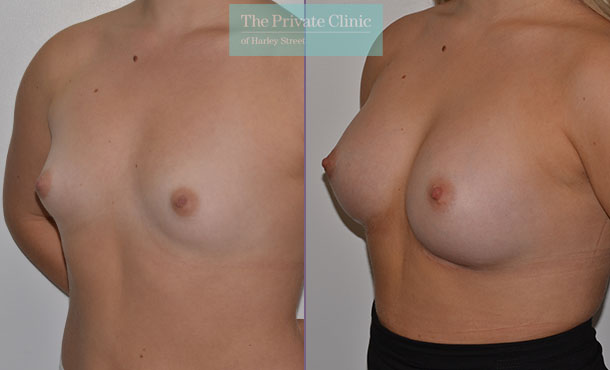 Breast Augmentation - 014AR-Side