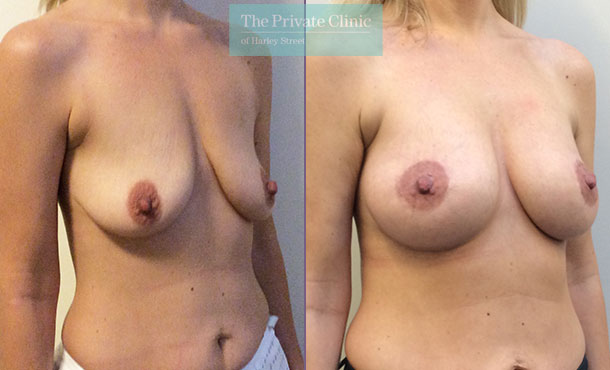 breast augmentation enlargement implants london clinic before after results mr davood fallahdar angle 004DF