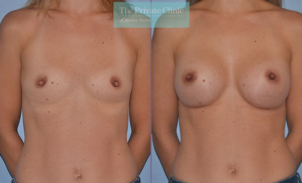 breast augmentation enlargement implants specialist before after results mr adrian richards front 007AR
