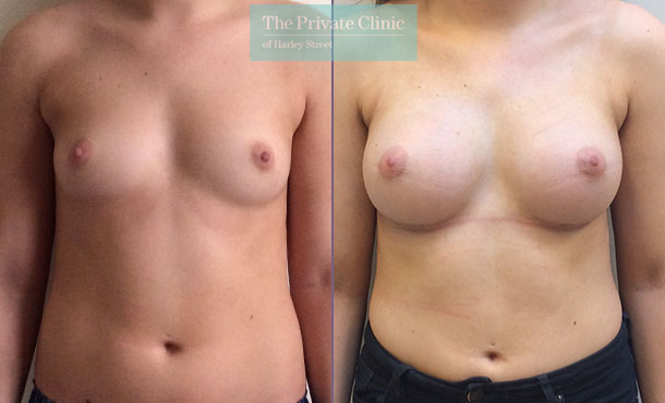 breast augmentation enlargement near me clinic before after results mr davood fallahdar front 007DF