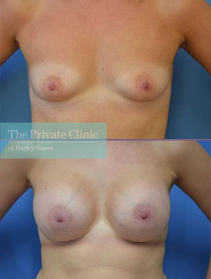 breast augmentation enlargement surgery before after photo mr adel fattah front 001AF