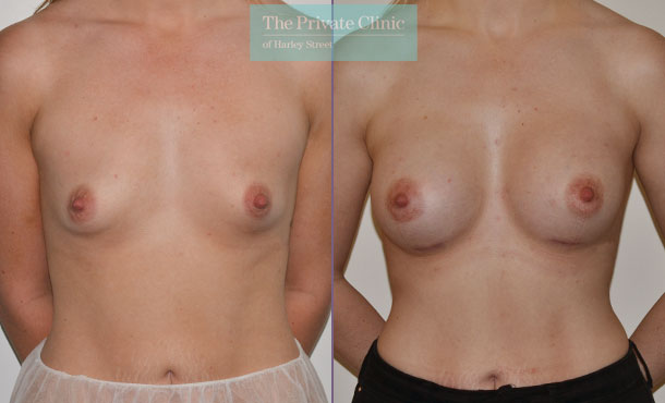 breast augmentation enlargement surgery before after photo results mr adrian richards front 008AR