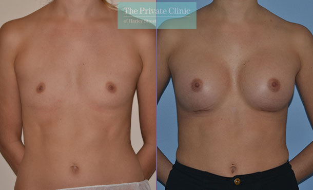 breast augmentation enlargement surgery costs uk before after photos mr adrian richards front 003AR