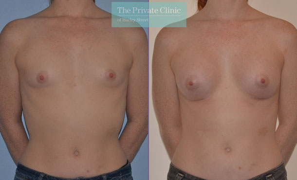 breast augmentation enlargement surgery london before after results mr adrian richards front 005AR