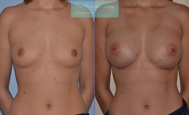 breast augmentation enlargement surgery uk before after photo results mr adrian richards front 002AR