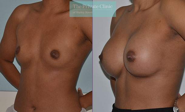 breast augmentation enlargement uk london before after results mr adrian richards angle 013AR