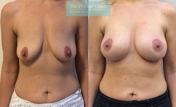 breast augmentation implants nearme london before after results mr davood fallahdar front 004DF