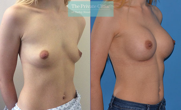breast augmentation implants surgery before after results mr adrian richards angle 001AR