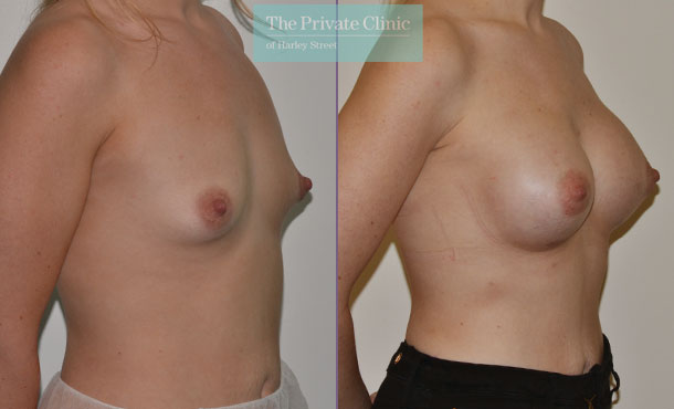 breast augmentation implants surgery before after results mr adrian richards angle 008AR