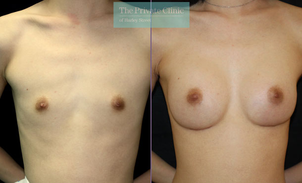 breast augmentation implants uk before after results mr dario rochira front 001DR