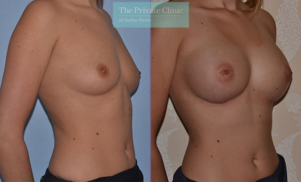 breast augmentation london enlargement implants surgery before after photo mr adrian richards angle 002AR