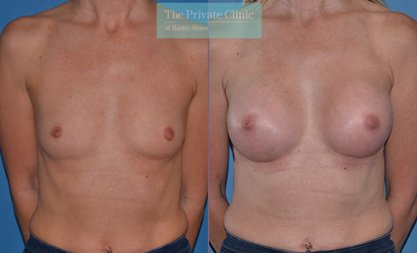 breast augmentation surgery implants before after photo results mr adrian richards front 010AR