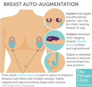 breast auto augmentation lift natural enhancement