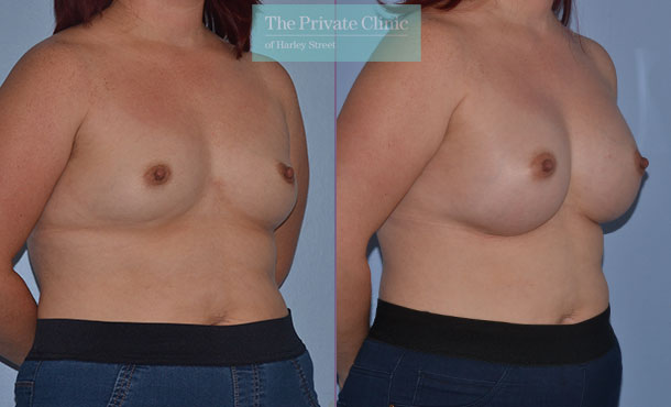 breast enlargement augmentation before after results mr adrian richards angle 004AR