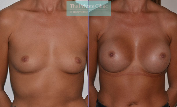 breast enlargement augmentation implants before after photo results mr adrian richards front 012AR