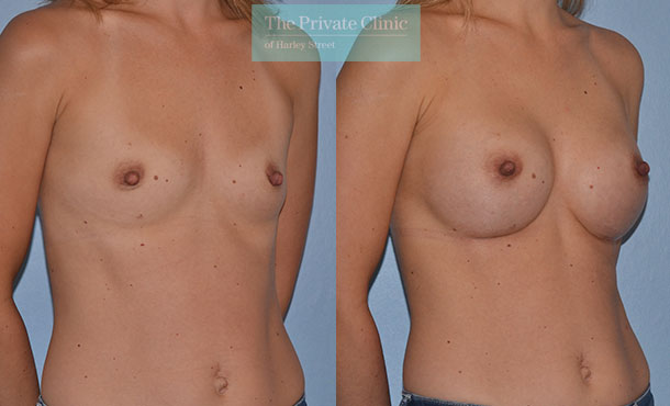 breast enlargement augmentation implants surgery before after results mr adrian richards angle 007AR