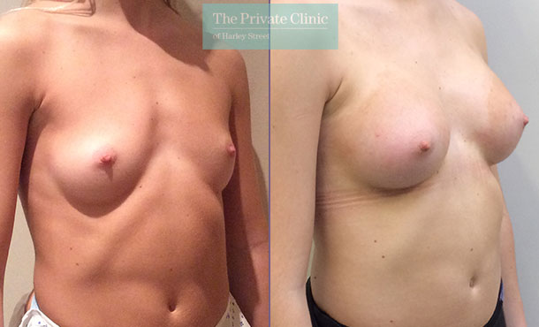 breast enlargement augmentation surgery london before after results mr davood fallahdar angle 003DF