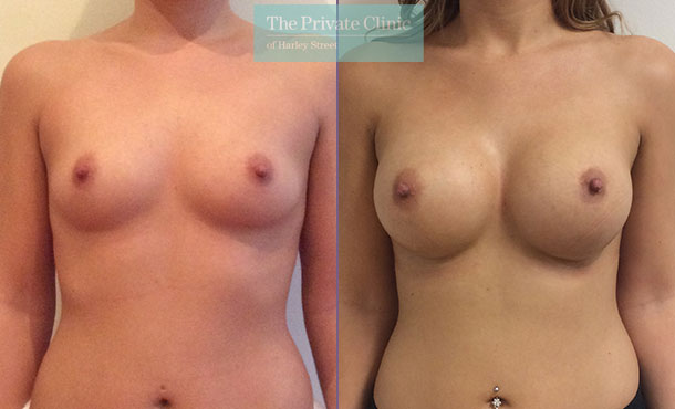 breast enlargement implants clinic london before after results mr davood fallahdar front 005DF