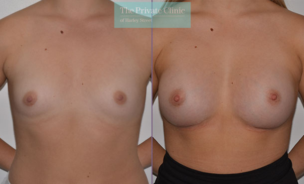 breast enlargement implants surgery before after photo results mr adrian richards front 014AR