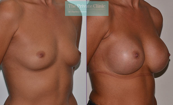 Breast Augmentation - 012AR-Side