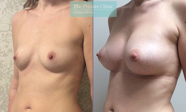 Breast Augmentation - 008DF-Side