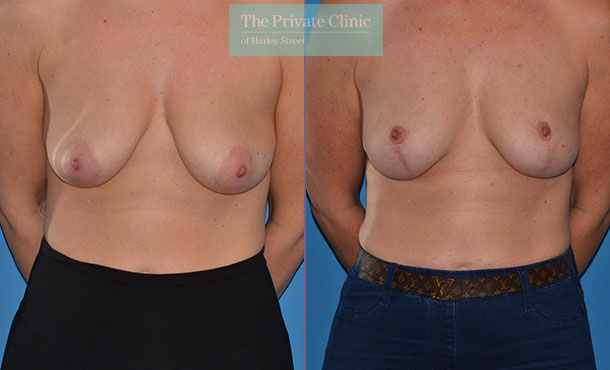 breast lift dropping breasts surgery before after results photos mr adrian richards front 021AR