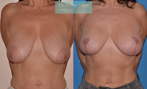 Breast Uplift - 022AR-Front