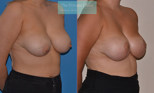 Breast Uplift - 019AR-Side