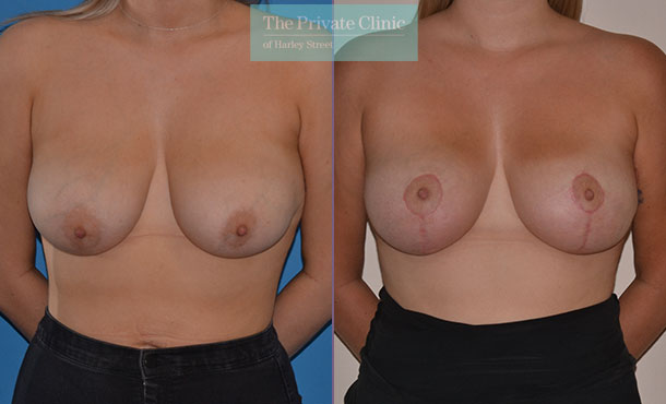 breast lift mastopexy surgery before after results photos mr adrian richards front 019AR