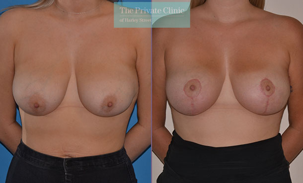 Breast Uplift - 019AR-Front