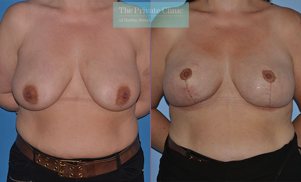 breast lift mastopexy surgery before after results photos mr adrian richards front 023AR