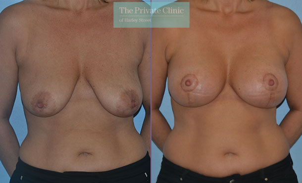 Breast Uplift with Implants - 025AR-Front