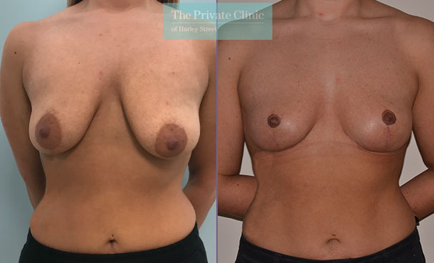 breast lift mastopexy surgery before after results photos mr adrian richards front 026AR