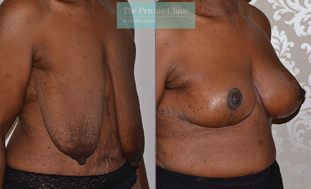 breast lift mastopexy surgery uk before after photos mr adrian richards side 016AR