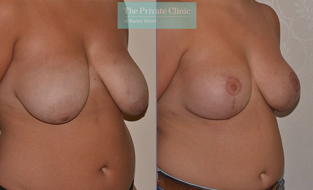 Breast Uplift - 017AR-Side