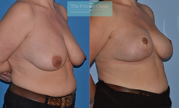 Breast Uplift - 023AR-Side