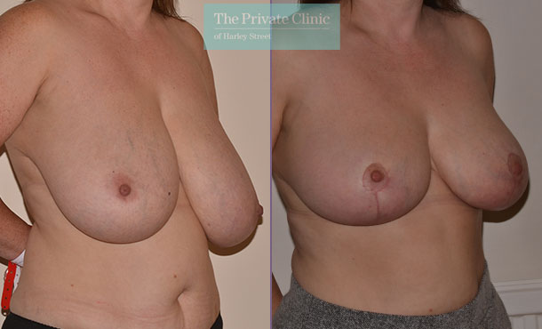 breast reduction surgery before after results photos mr adrian richards angle 027AR