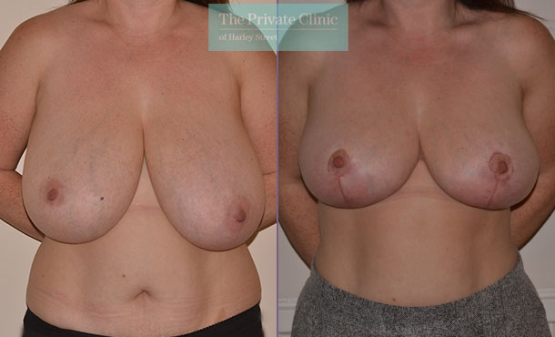 breast reduction surgery before after results photos mr adrian richards front 027AR