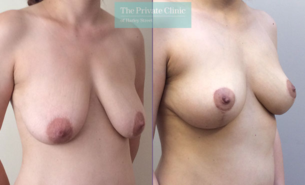 breast reduction surgery before after results photos mr davood fallahdar angle 009DF