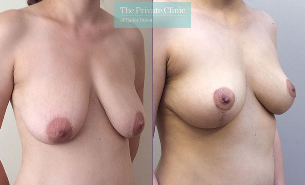 Breast Reduction- 009DF-Side