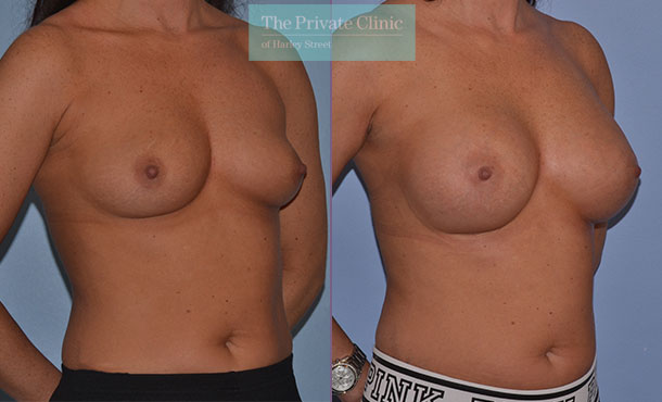 breast surgery augmentation enlargement implants before after results mr adrian richards angle 006AR