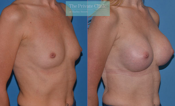 Breast Augmentation - 010AR-Side