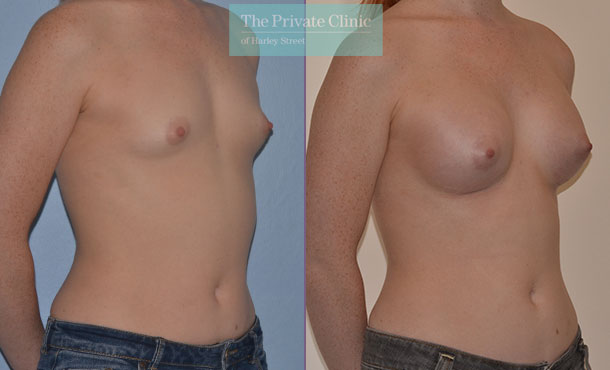 breast surgery augmentation implants before after results mr adrian richards angle 005AR